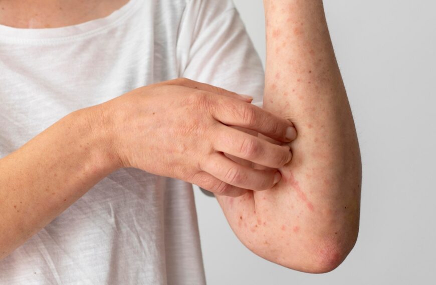 Casi el 20% de los castellanomanchegos cree que la dermatitis atópica es contagiosa