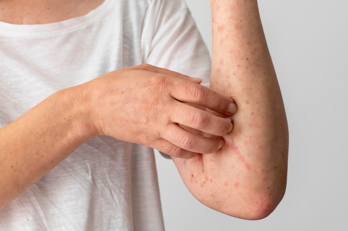 Casi el 20% de los castellanomanchegos cree que la dermatitis atópica es contagiosa